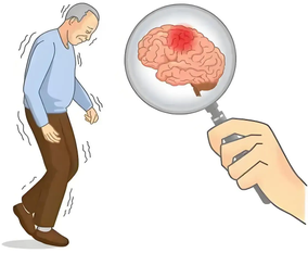 Parkinson's disease is a chronic, progressive neurological disorder characterized by symptoms such as resting tremors, bradykinesia, muscle rigidity, and postural balance disorders. Parkinson's disease is a chronic, progressive neurological disorder characterized by symptoms such as resting tremors, bradykinesia, muscle rigidity, and postural balance disorders.